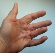 Beugekontraktur links Am kleinen Finger und Ringfinger haben sich deutliche Stränge gebildet. Die Finger lassen sich nicht mehr strecken.