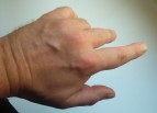 Hand von oben Von oben sieht man deutliche Streckhemmung.