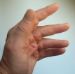 Seitenaufsicht Morbus Dupuytren Seitenansicht der Hand. Auch hier erkennt man die Streckhemmung, vornehmlich im Grundgelenk der Finger.